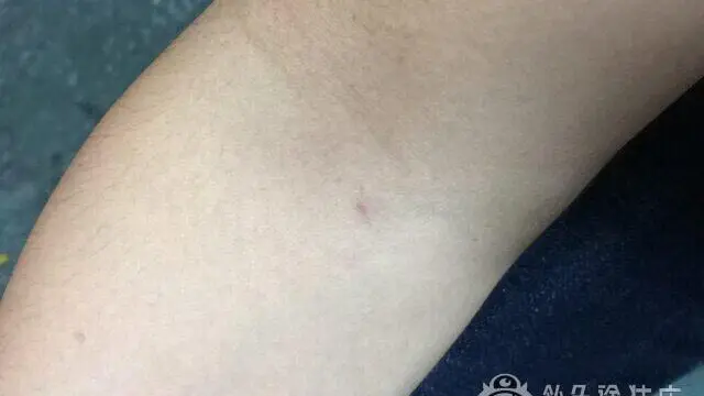 健康診断 チクッのサムネイル